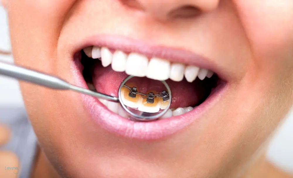 a close up photo of lingual braces as one of the alternatives to braces in Fort Myers, Cape Coral and Lehigh Acres, FL