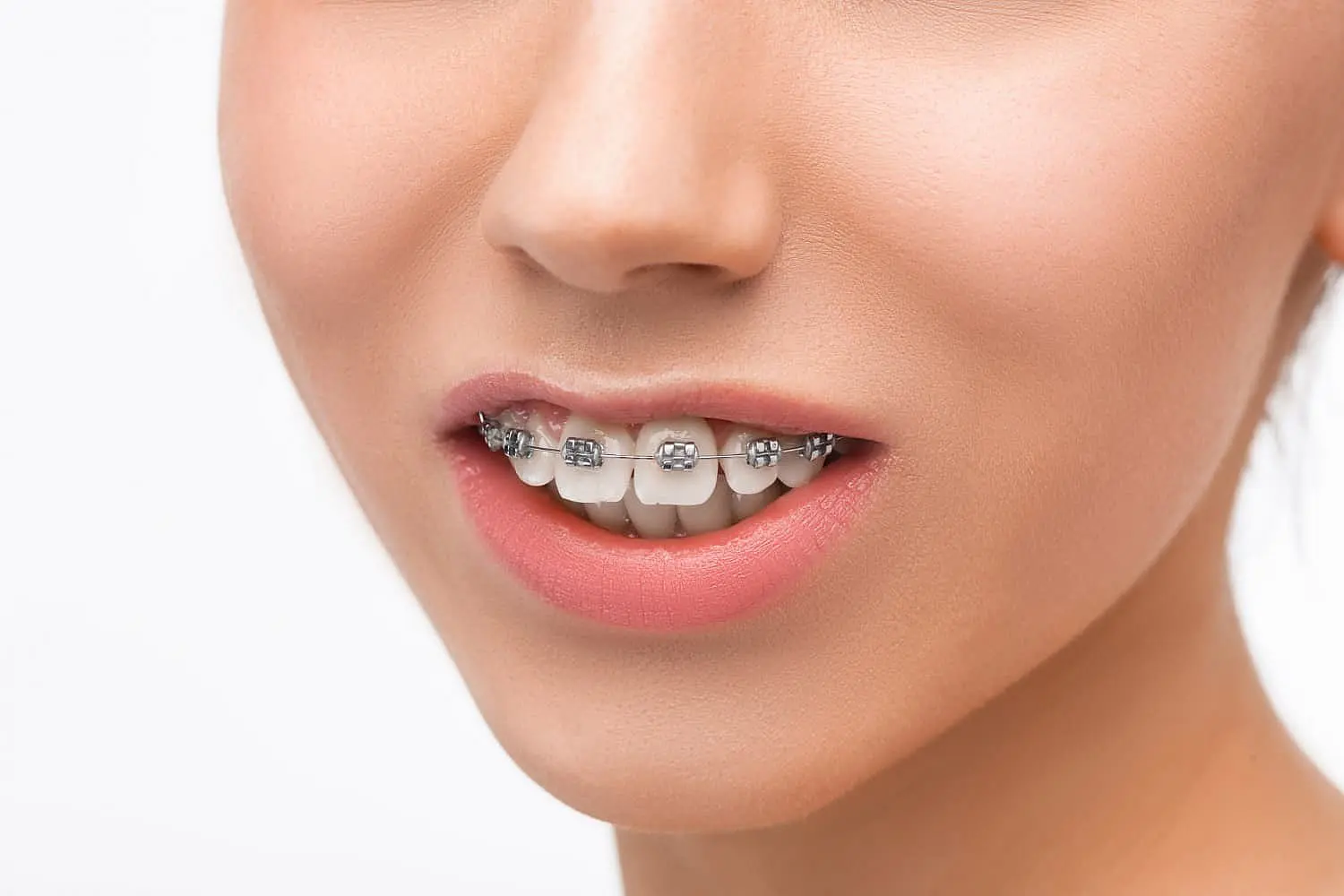 A close-up shows braces expertly aligning teeth and correcting an overbite at Levine Orthodontics in Fort Myers, Cape Coral or Lehigh Acres, FL.