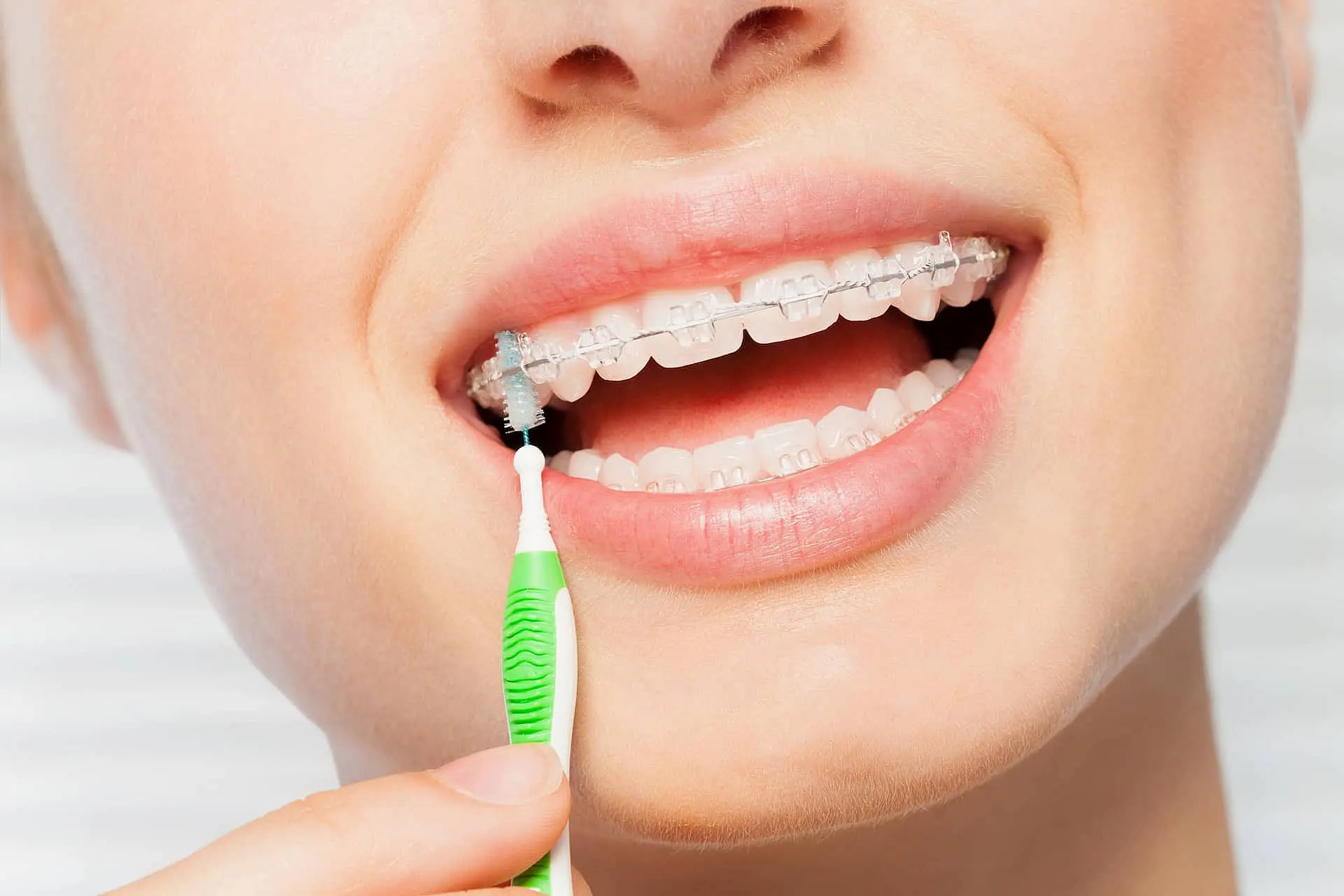 A person uses an interdental brush to clean their clear braces at Levine Orthodontics in Fort Myers, Cape Coral or Lehigh Acres, FL.