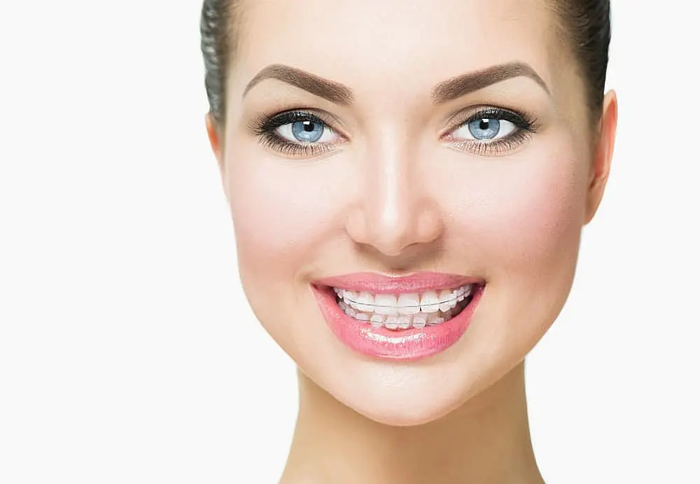 A smiling person shows off their clear braces, provided by Levine Orthodontics in Fort Myers, Cape Coral or Lehigh Acres, FL, against a plain white background.