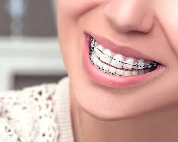 A close-up of a person smiling with clear ceramic braces can be seen at Levine Orthodontics in Cape Coral, FL.