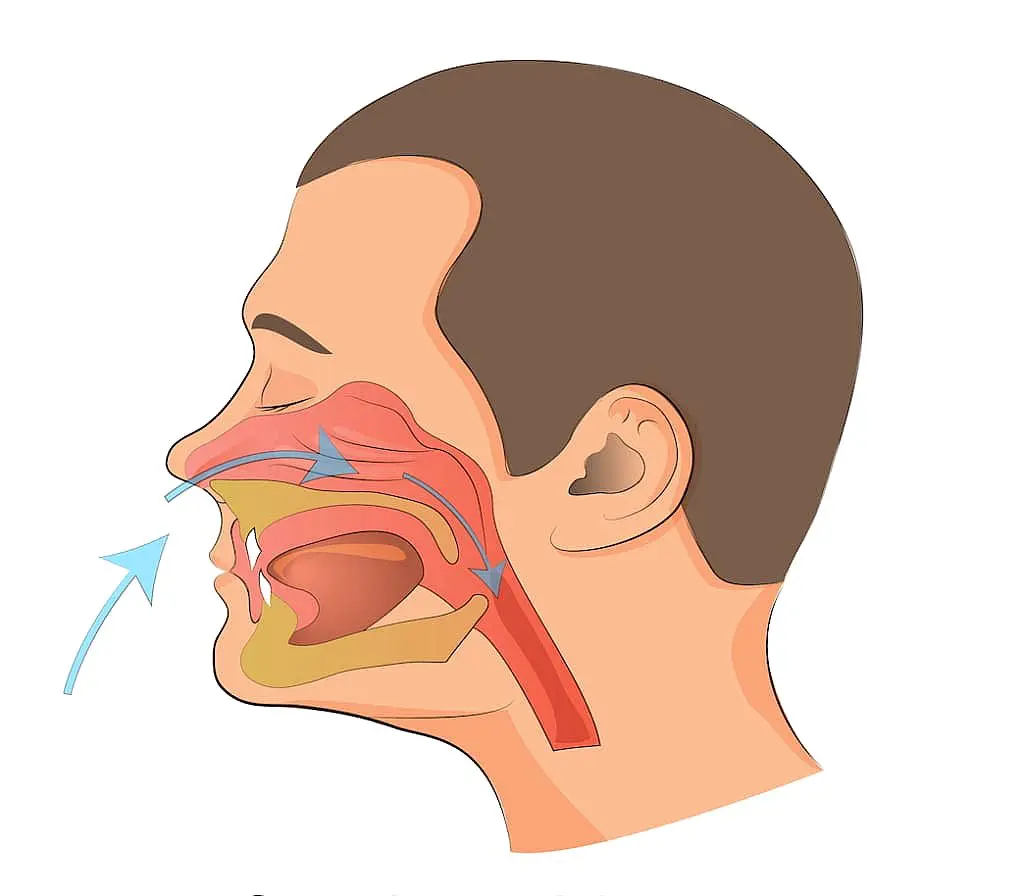 A diagram of a human head profile illustrates the nasal cavity, mouth and throat passages with arrows showing airflow direction, highlighting a mouth breather’s airflow route. Available at Levine Orthodontics in Fort Myers, Cape Coral or Lehigh Acres, FL.