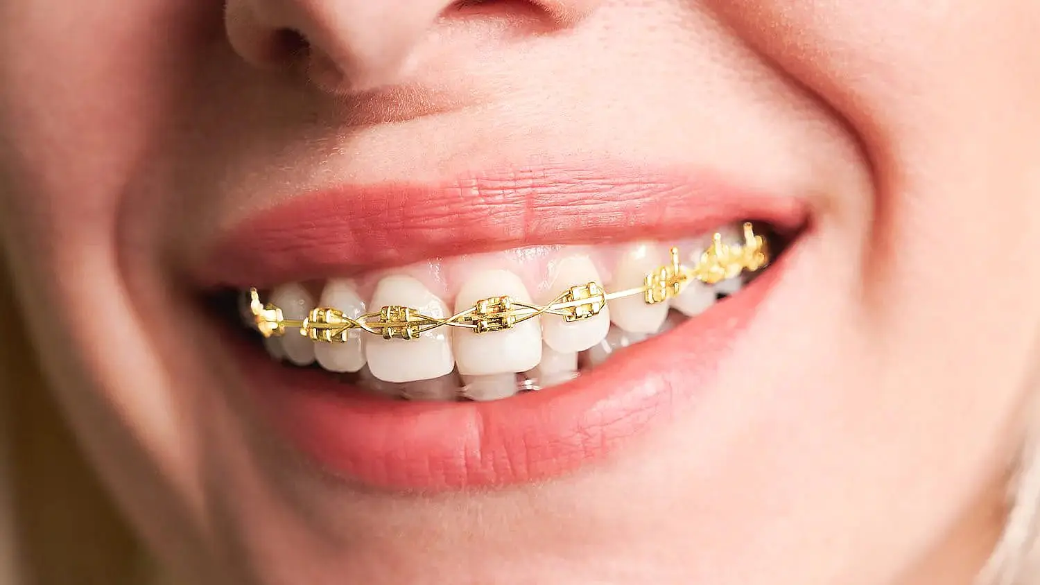 A person beams a radiant smile, showcasing their gold braces at Levine Orthodontics in Fort Myers, Cape Coral or Lehigh Acres, FL.