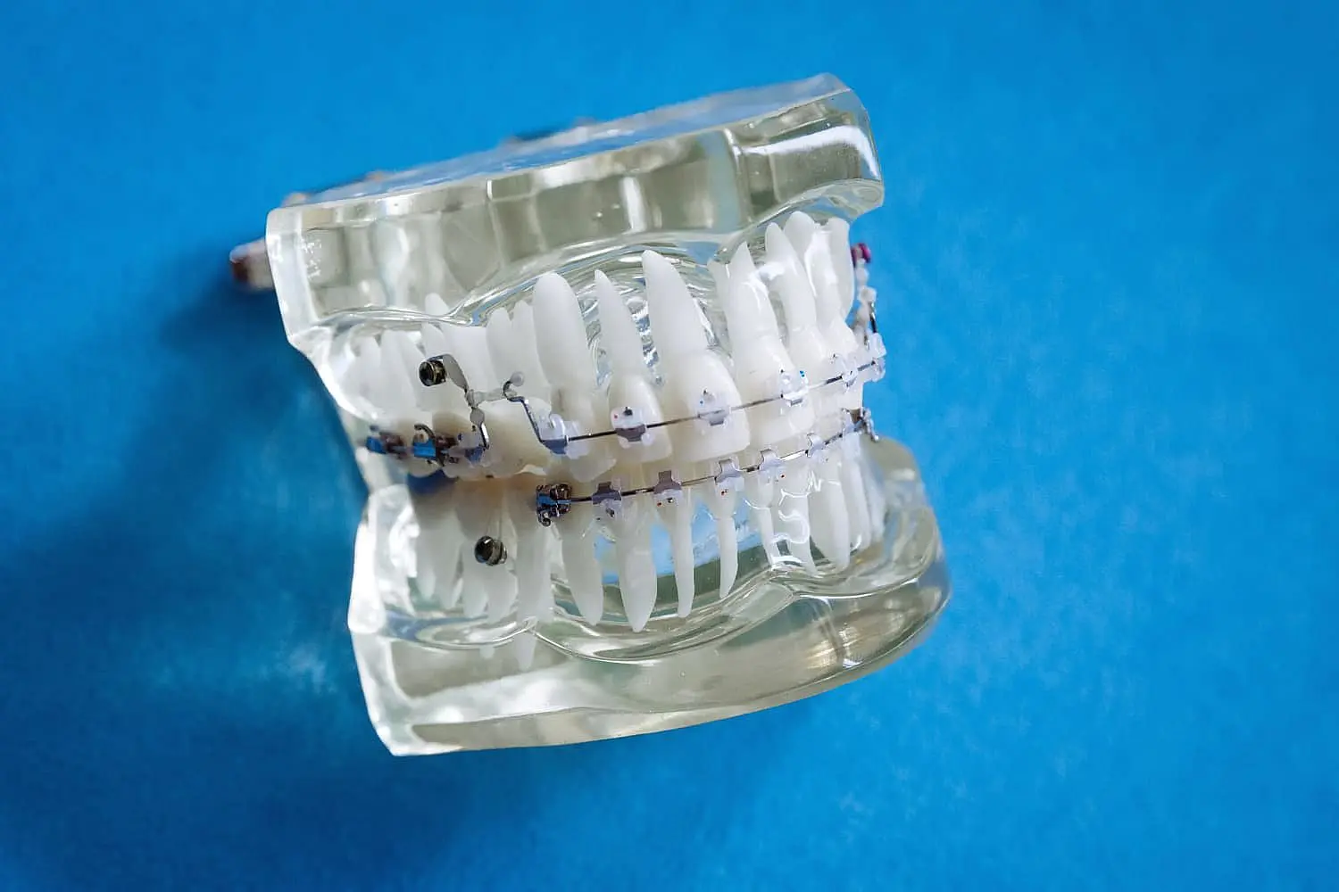 A clear dental model displays teeth with metal braces against a blue background at Levine Orthodontics in Fort Myers, Cape Coral or Lehigh Acres, FL.