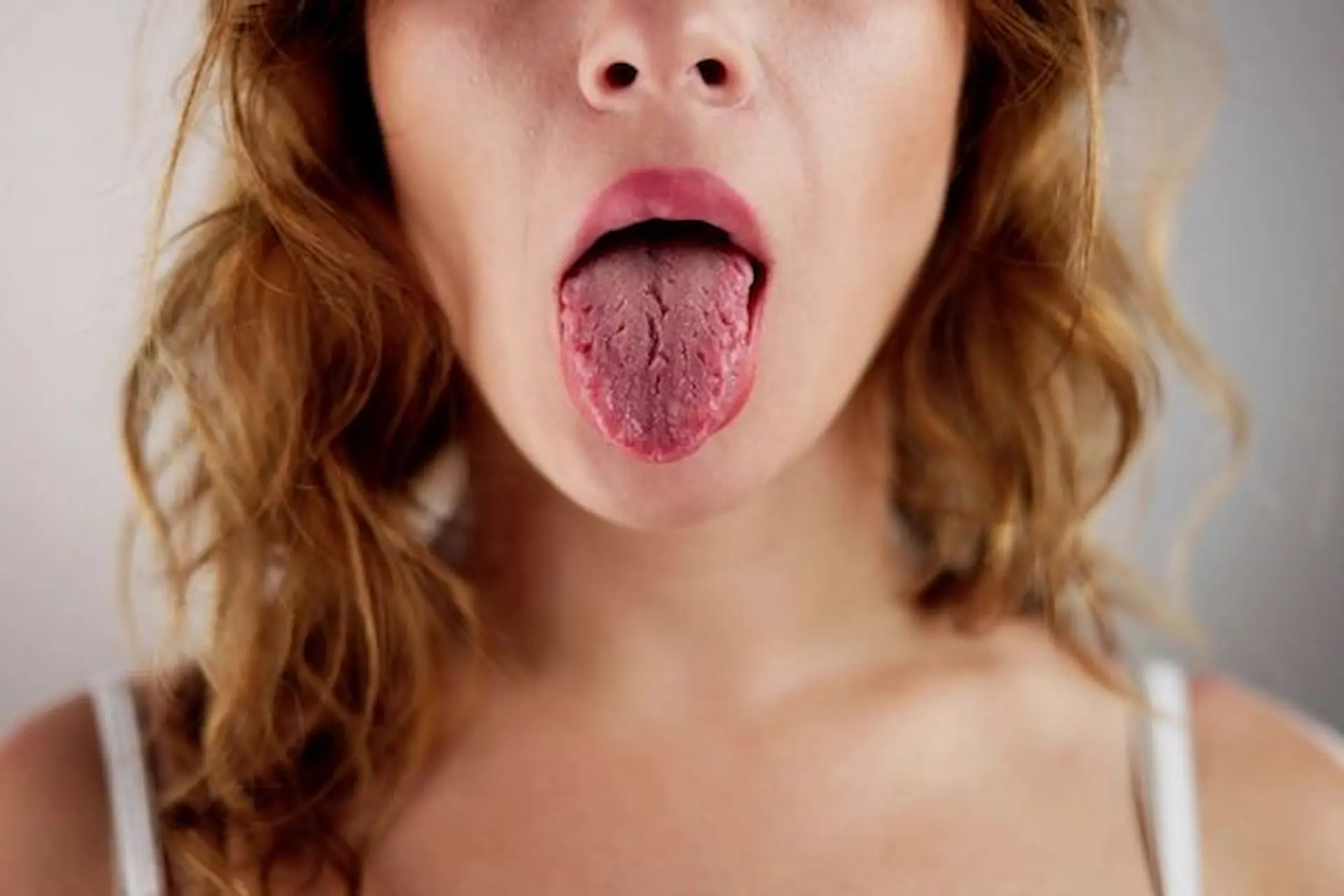 At Levine Orthodontics in Fort Myers, Cape Coral, or Lehigh Acres, FL, a woman with wavy hair displays a dry, cracked tongue—signs that may indicate mouth breathing.