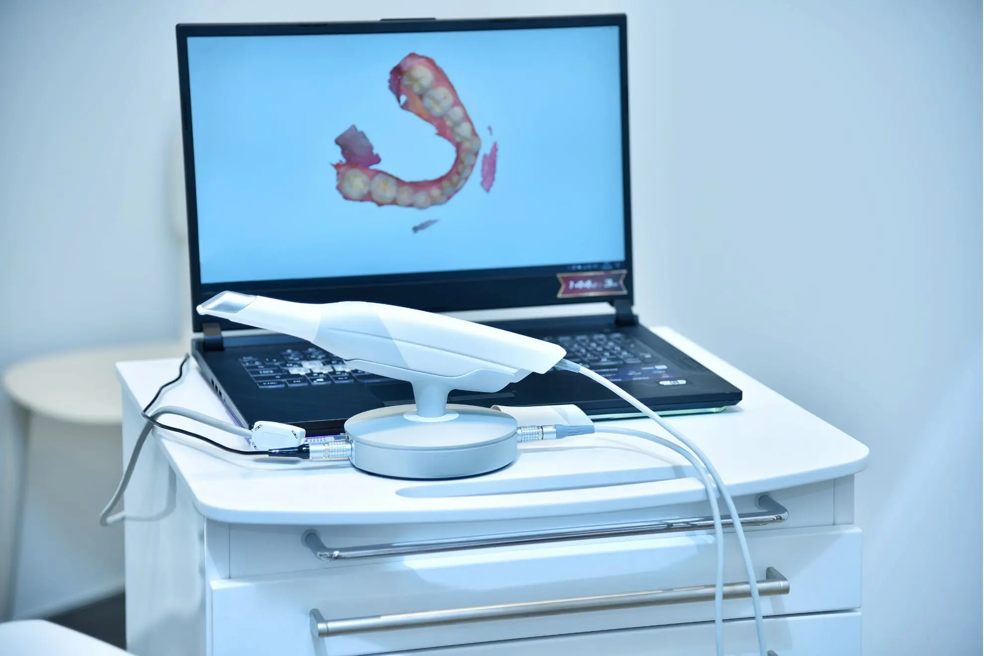 A dental scanner at Levine Orthodontics in Cape Coral, FL, connected to a laptop displaying a 3D digital teeth model, illustrating our high precision Invisalign aligners process for personalized orthodontic treatment.