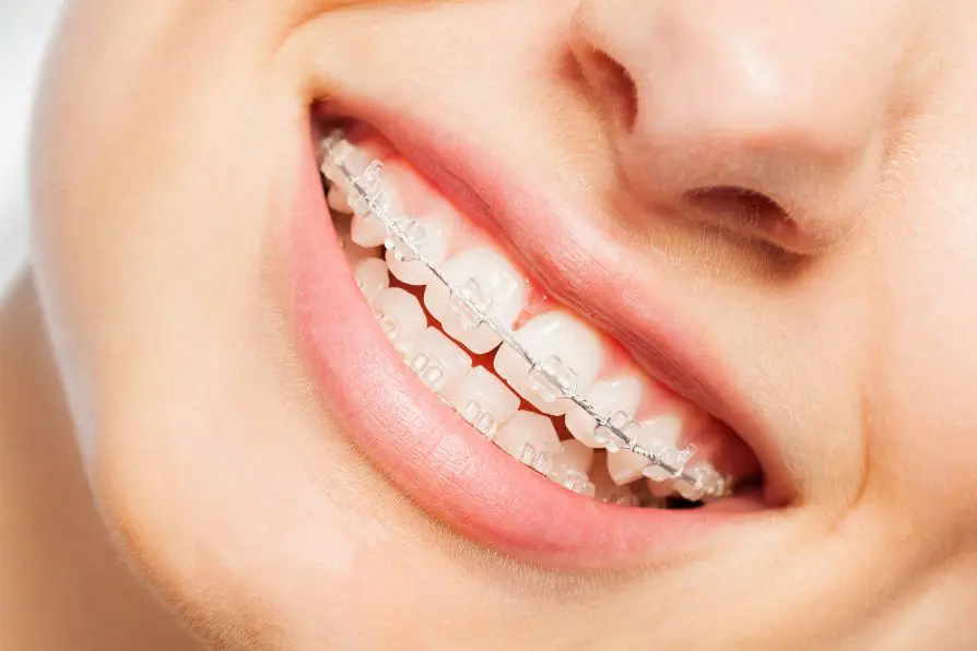 A woman shows off her clear ceramic braces—an example of the confident smiles created by Levine Orthodontics in Lehigh Acres, FL.