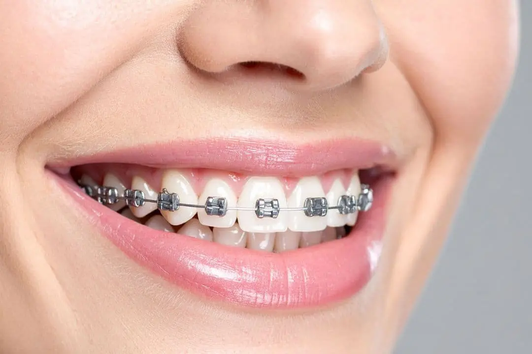 Smiling person proudly showing metal braces from Levine Orthodontics in Cape Coral, FL, highlighting expert orthodontic care and confident results.