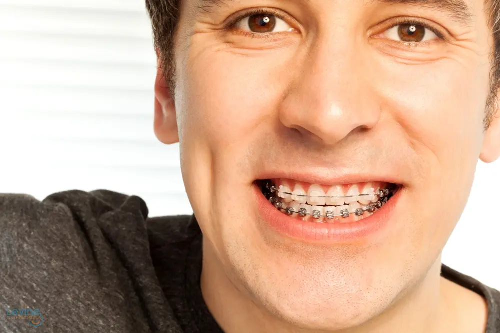 happy young man with metal braces - Overbite vs Underbite in Fort Myers, Cape Coral, and Lehigh Acres, FL
