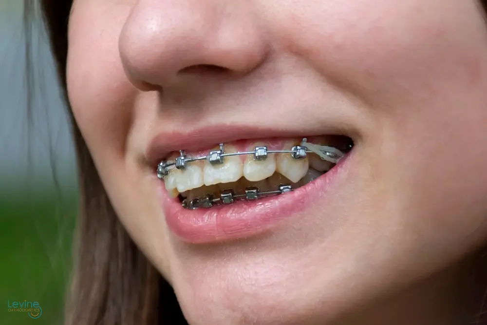 smiling girl metal braces her teeth - Overbite vs Underbite in Fort Myers, Cape Coral, and Lehigh Acres, FL.