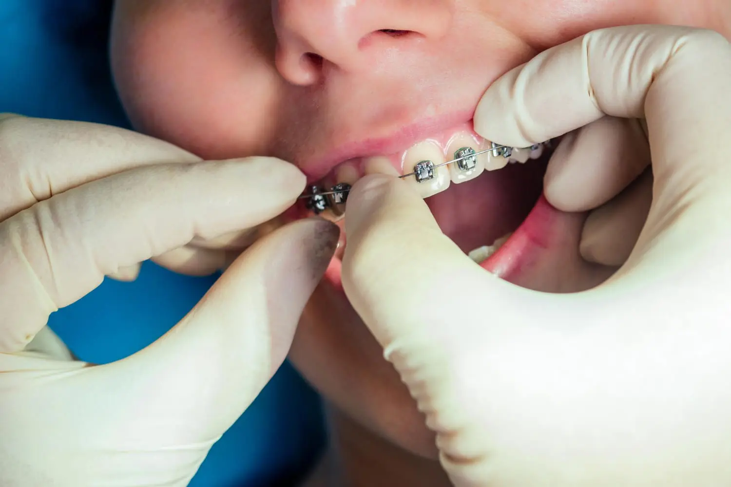 At Levine Orthodontics in Lehigh Acres, FL, a dentist adjusts braces on a patient's upper teeth before removal.